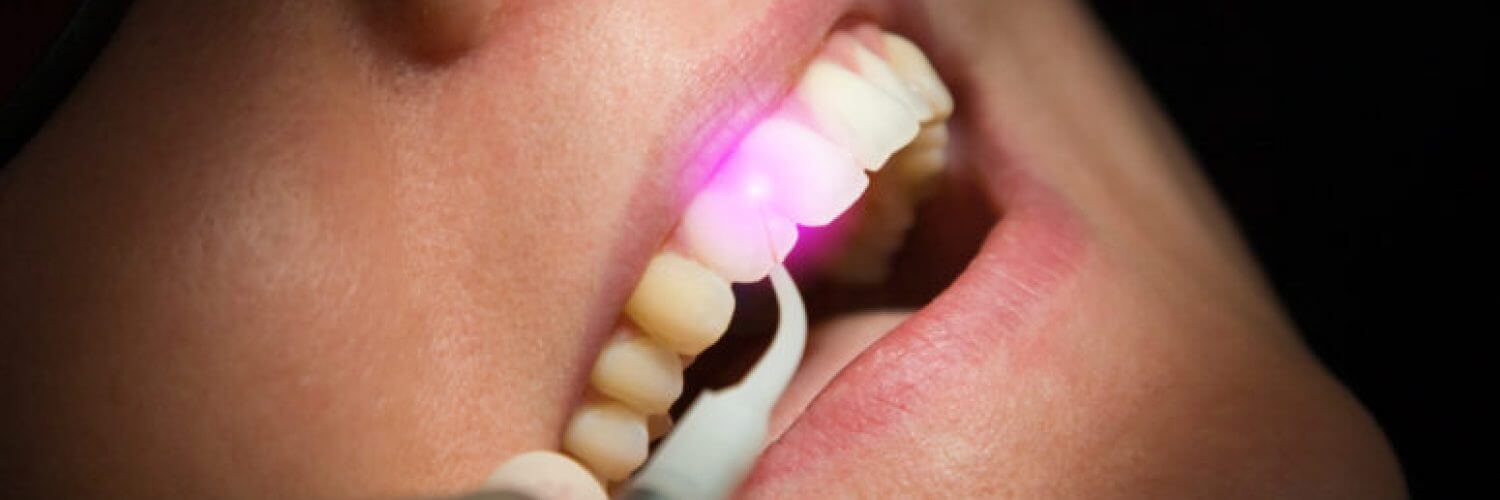 Nd:Yag Laser Enhanced Gum Treatment